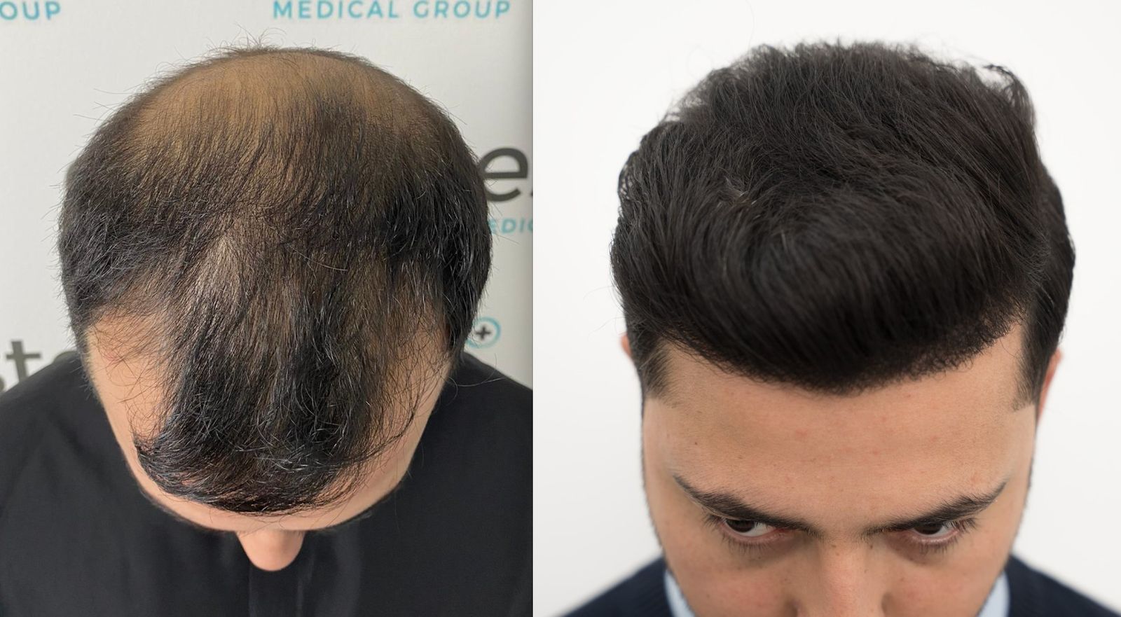 1 Year After Hair Transplant, Birmingham Man Shares New Hair Growth